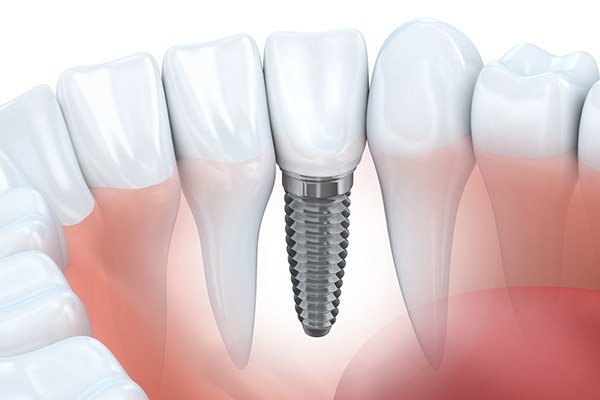 Reasons For A Periodontist To Place Dental Implants