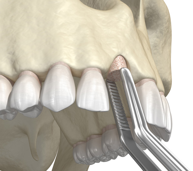 Summit Bone Grafting for Dental Implants