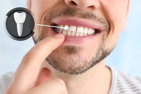 When Tooth Extraction With Dental Implants Is Recommended