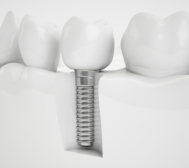 Summit Dental Implants