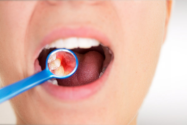 How A Periodontist May Treat Severe Gum Disease