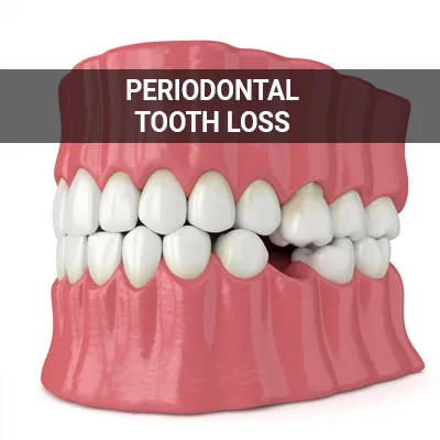 Visit our Periodontal Tooth Loss page